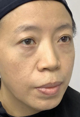 去眼袋手术