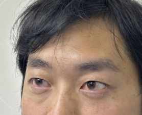 去眼袋手术