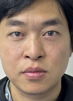 去眼袋手术