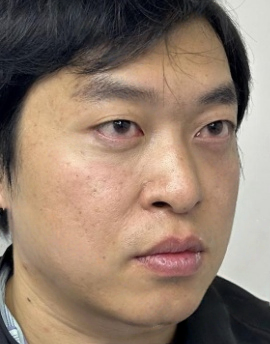 去眼袋手术