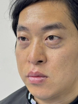 去眼袋手术