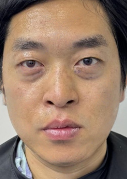 去眼袋手术