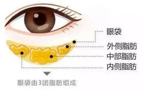 去眼袋手术
