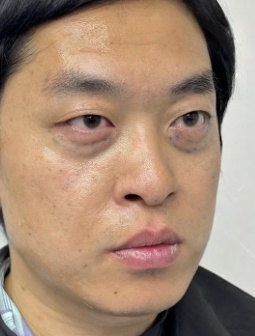 去眼袋手术
