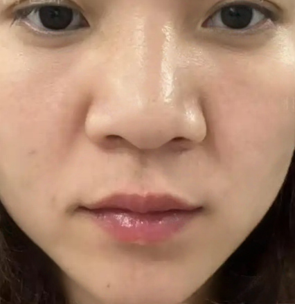 去眼袋手术