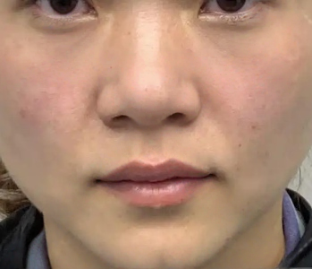 去眼袋手术