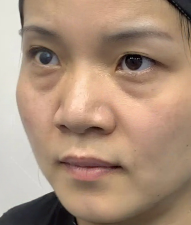 去眼袋手术