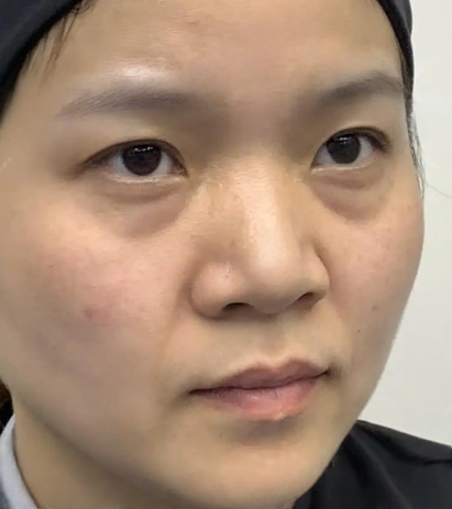 去眼袋手术