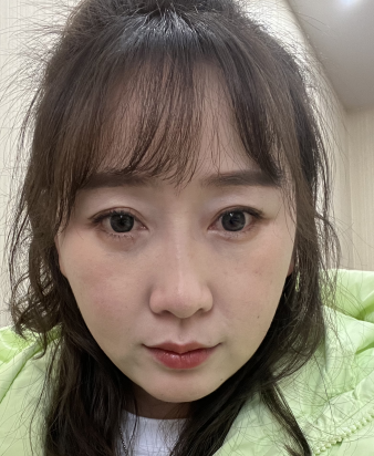 去眼袋手术