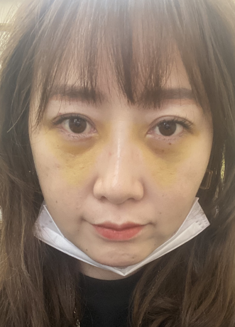 去眼袋手术