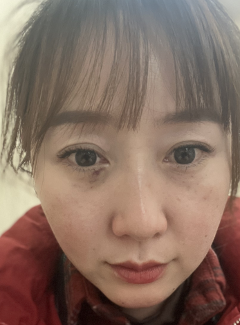 去眼袋手术