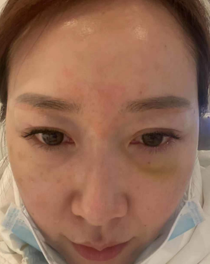 去眼袋手术