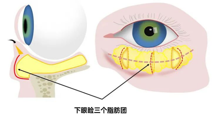 去眼袋手术