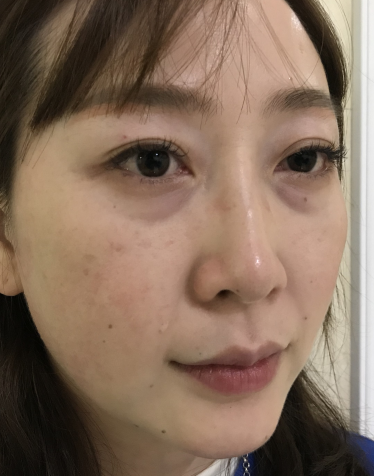 去眼袋手术