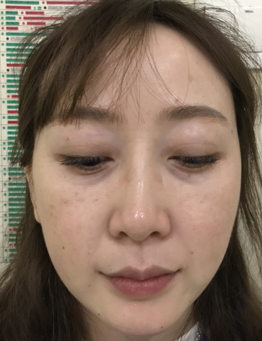 去眼袋手术