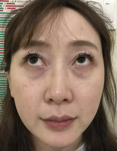 去眼袋手术