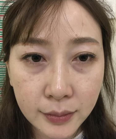 去眼袋手术