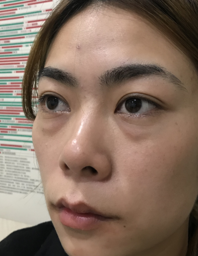 去眼袋手术