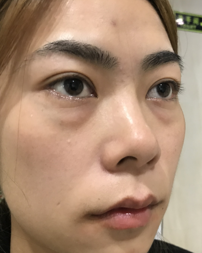 去眼袋手术