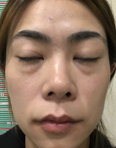 去眼袋手术