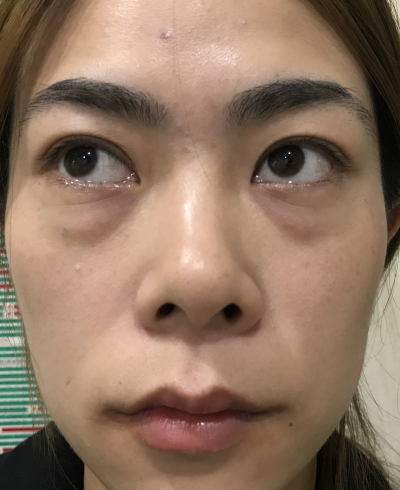 去眼袋手术