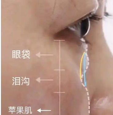去眼袋手术