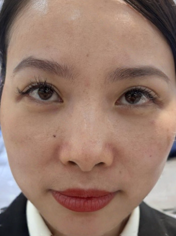 去眼袋手术
