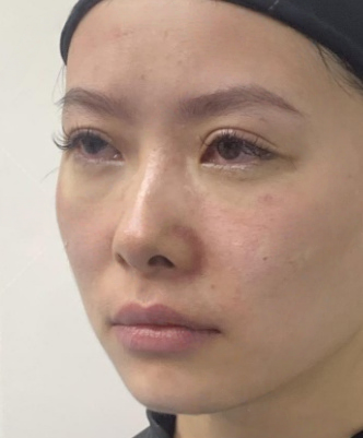 去眼袋手术