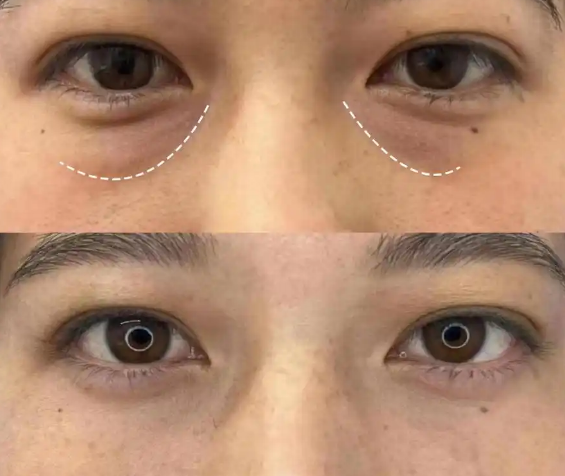 去眼袋手术