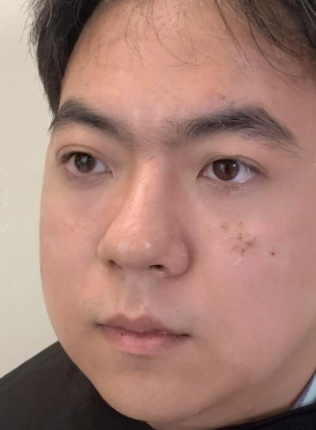 去眼袋手术