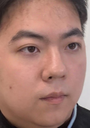 去眼袋手术