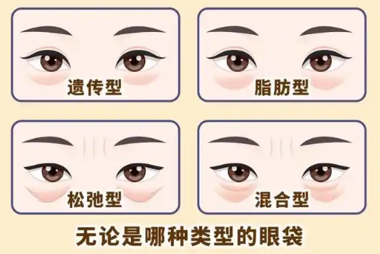 去眼袋手术