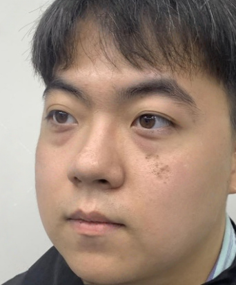去眼袋手术