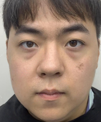 去眼袋手术