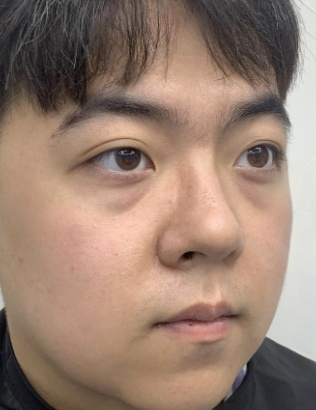 去眼袋手术