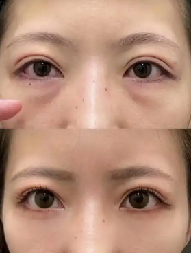 眼袋