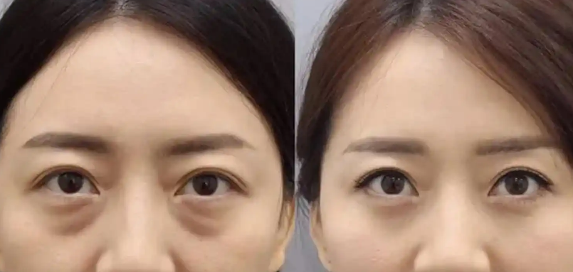 去眼袋手术
