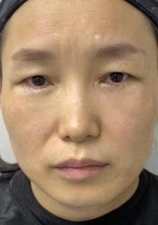 去眼袋手术