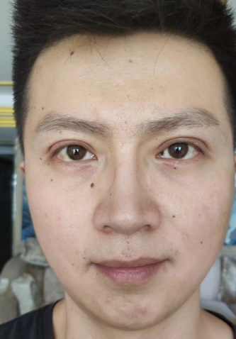 眼袋