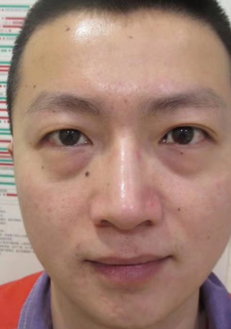 眼袋