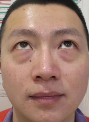 眼袋