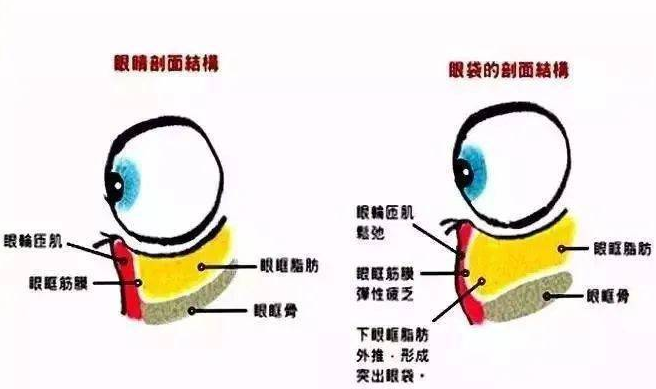 去眼袋手术