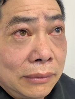 去眼袋手术