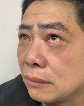 去眼袋手术