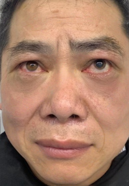 去眼袋手术
