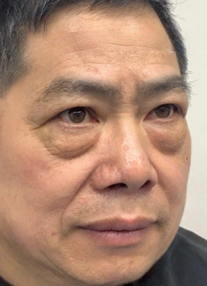 去眼袋手术