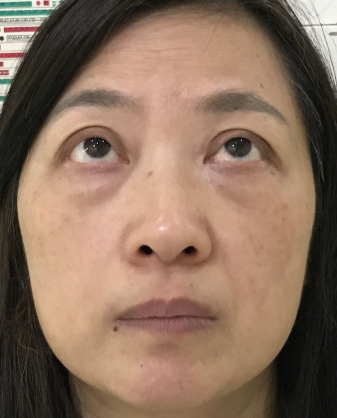 去眼袋手术