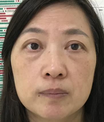 去眼袋手术