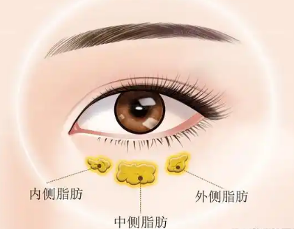 去眼袋手术