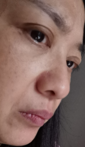 去眼袋手术